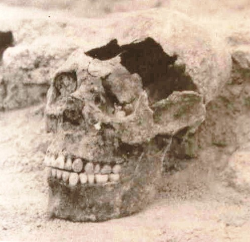 Skull with deformation