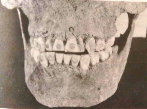 skull with inlaid teeth